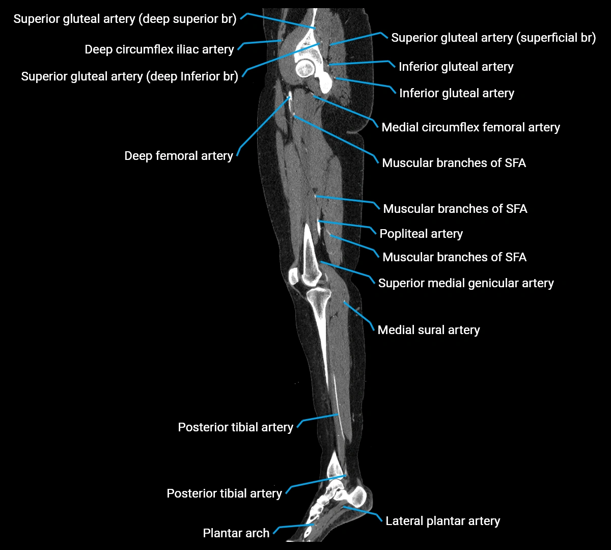 CTA lower limb sagittal cross sectional anatomy labelled image _36 (3).webp